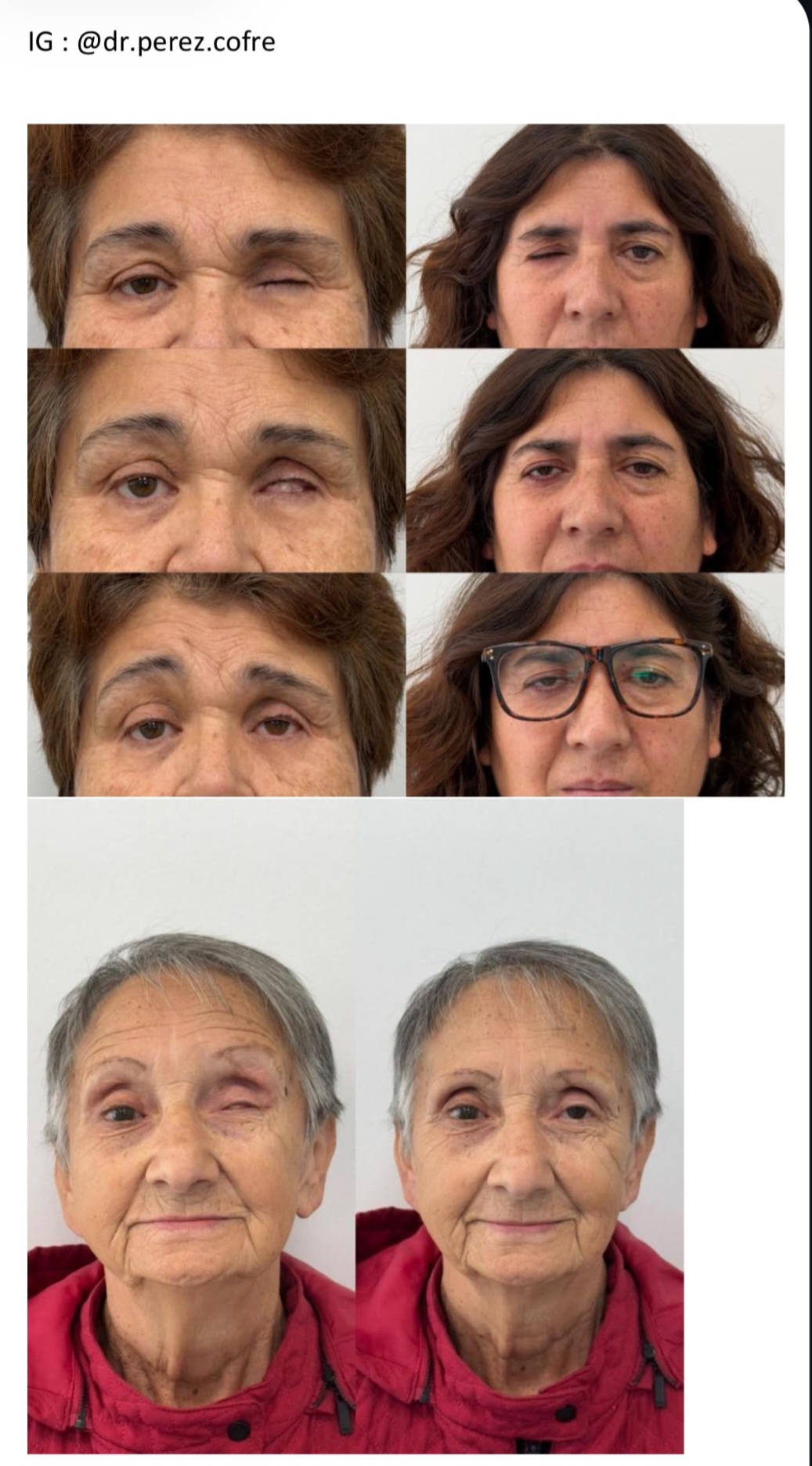 Importante adelanto con prótesis para personas con problemas a la…